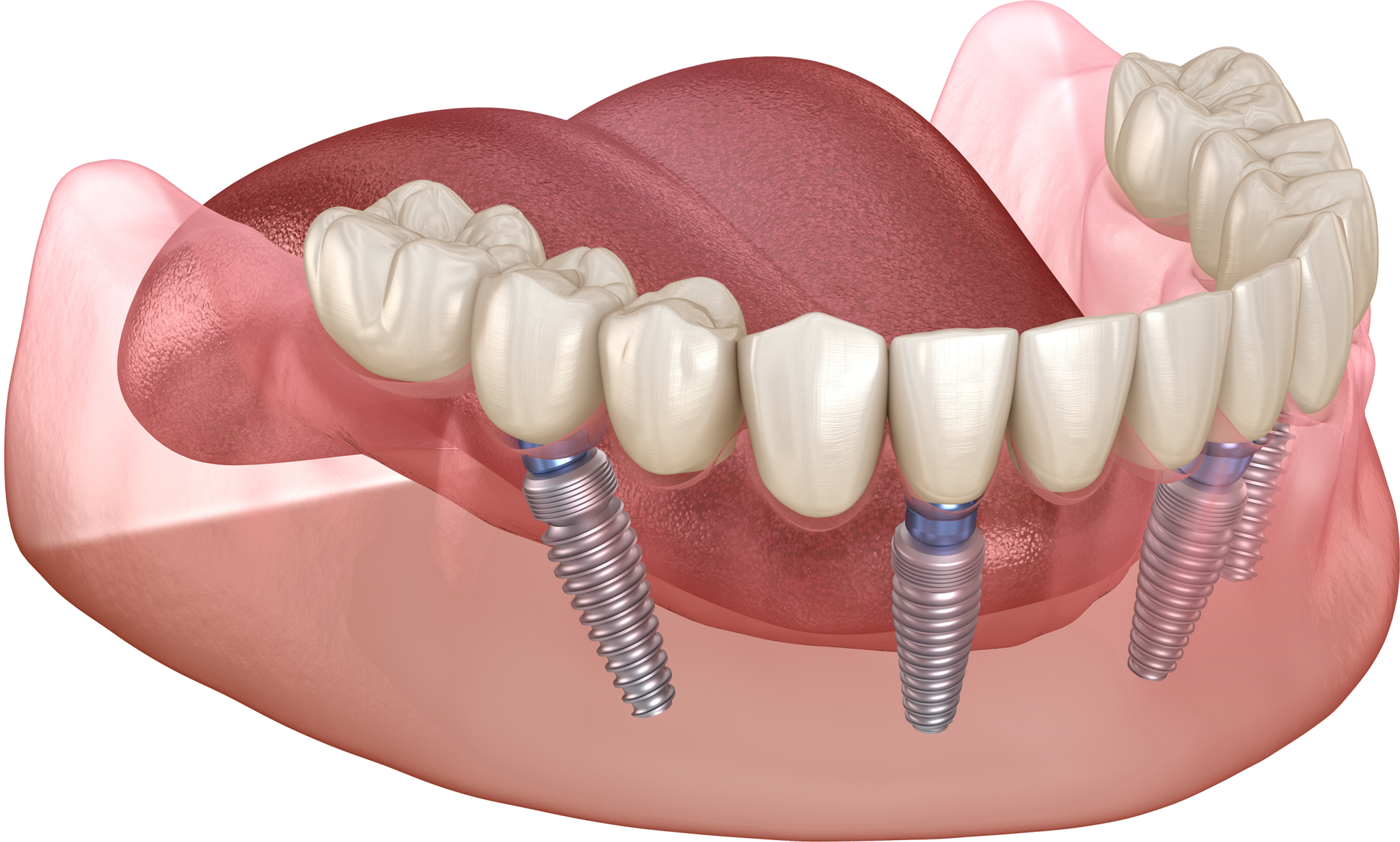 Несъемный зубной протез на 4 имплантах